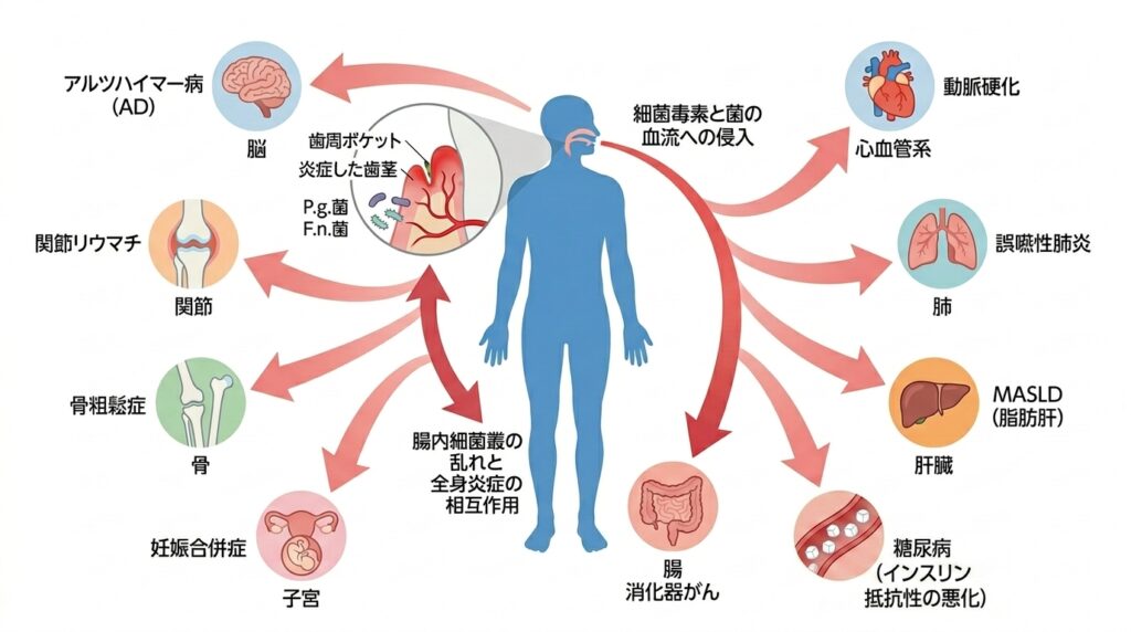 歯周病が血流を介して脳、心臓(動脈硬化)、糖尿病(インスリン抵抗性の悪化)、肺、子宮(早産)へ悪影響を及ぼし、逆に糖尿病が歯周病を悪化させる双方向の関係を示す全身マッピング図。