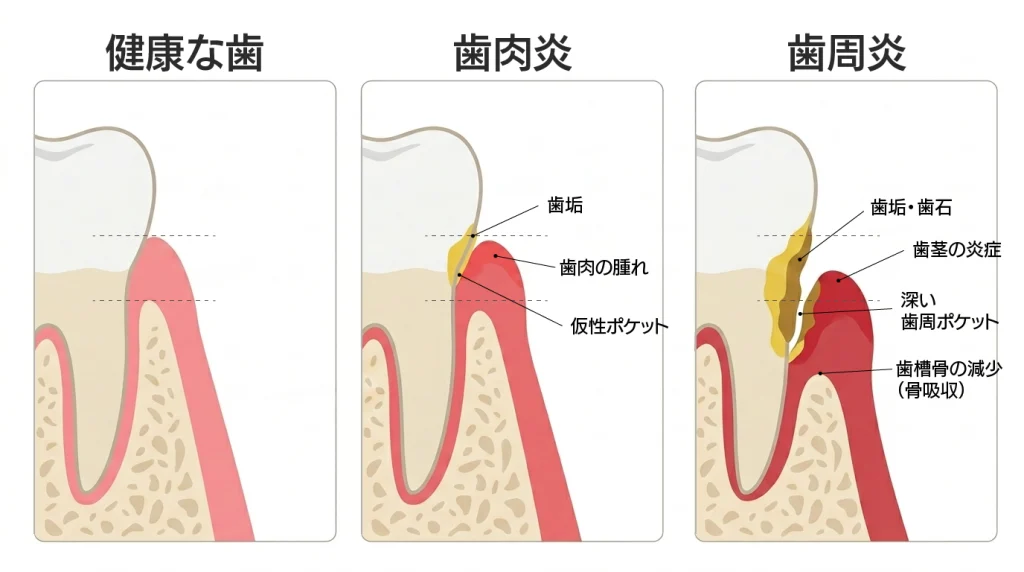 健康な歯肉から、歯肉炎(仮性ポケット)、歯周炎(歯槽骨の吸収)へと悪化する歯周病の進行メカニズムの断面図
