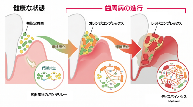 歯周病原細菌の代謝共生(クロスフィーディング)と、初期定着菌から赤色複合体への遷移によるディスバイオーシス(細菌叢のバランス崩壊)のメカニズム図