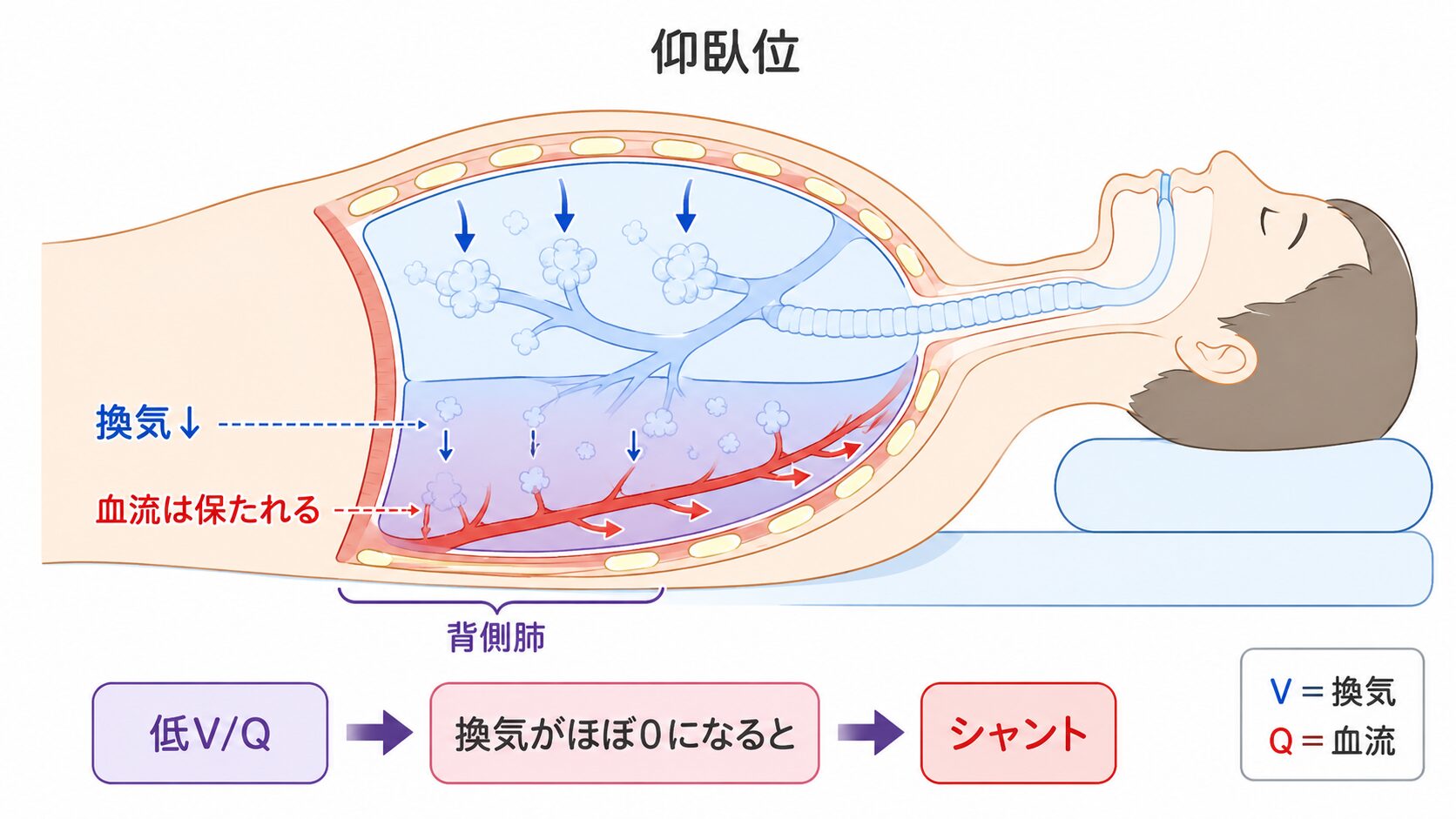 仰臥位で背側肺の換気が低下し、血流が保たれることで低V/Qからシャントへ至る流れを示す模式図